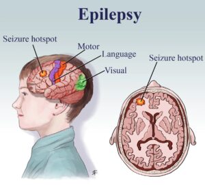 Epilepsy and Nutrition: How Diet Can Help Manage Seizures