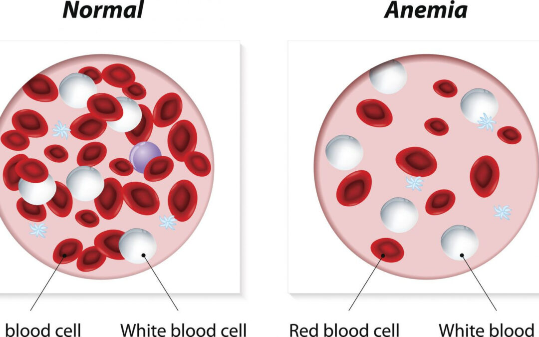 Anemia Diet – Boost Your Iron and Energy Naturally